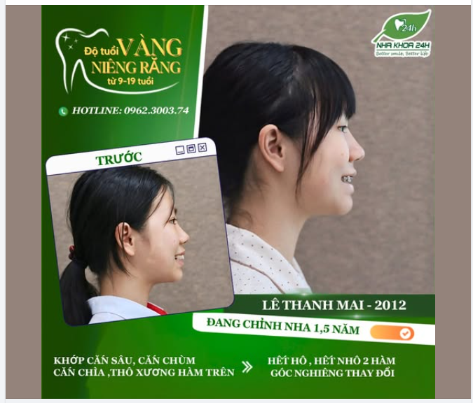 ĐỘ TUỔI VÀNG NIỀNG RĂNG (9 - 19 TUỔI) – BƯỚC ĐỆM THAY ĐỔI DIỆN MẠO HOÀN HẢO