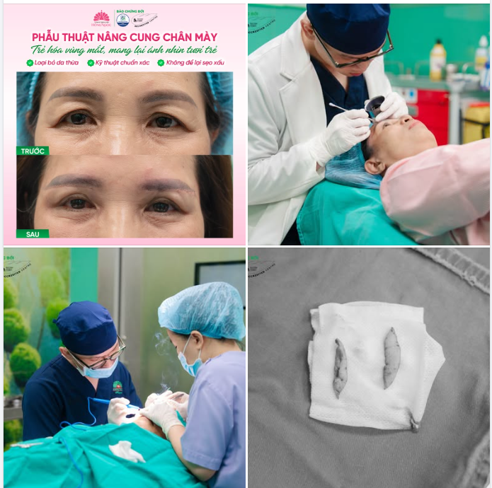NÂNG CUNG MÀY - XÓA DẤU HIỆU LÃO HÓA VÙNG MẮT, LẤY LẠI ÁNH NHÌN TƯƠI TRẺ TỰ NHIÊN
