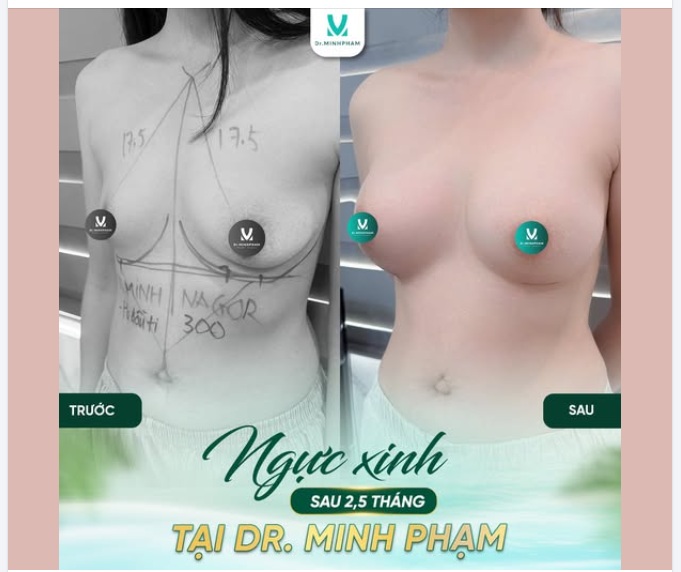 Một vòng 1 hài hòa không chỉ giúp vóc dáng cân đối hơn mà còn khiến bạn tự tin diện mọi outfit, tự tin trong từng khoảnh khắc.