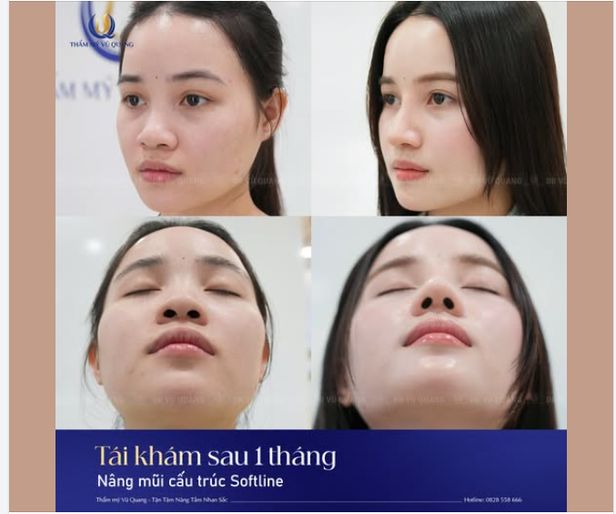 Vốn đã sở hữu làn da trắng sứ cùng các đường nét hài hòa, bạn Mỹ Hạnh nay lại càng thăng hạng nhan sắc, rạng rỡ đầy sức sống sau khi thực hiện nâng mũi tại Bác sĩ Vũ Quang.