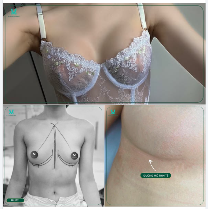 Kết quả đẹp thế này, chị em còn chần chừ gì mà chưa đến Dr. Minh Phạm để nâng cấp V1