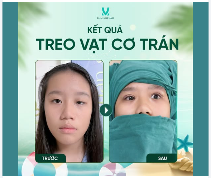 Bé Quỳnh Chi đến với Dr. Minh Phạm trong tình trạng mắt trái bị sụp mi, mắt phải có da dư, chùng nhẹ, khiến hai bên mắt thiếu sự cân đối.