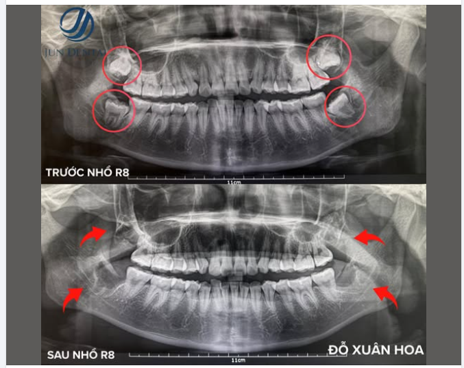 NHỔ 4 RĂNG KHÔN MỌC NGẦM – GIẢI PHÁP LOẠI BỎ NHỮNG PHIỀN TOÁI ÂM THẦM