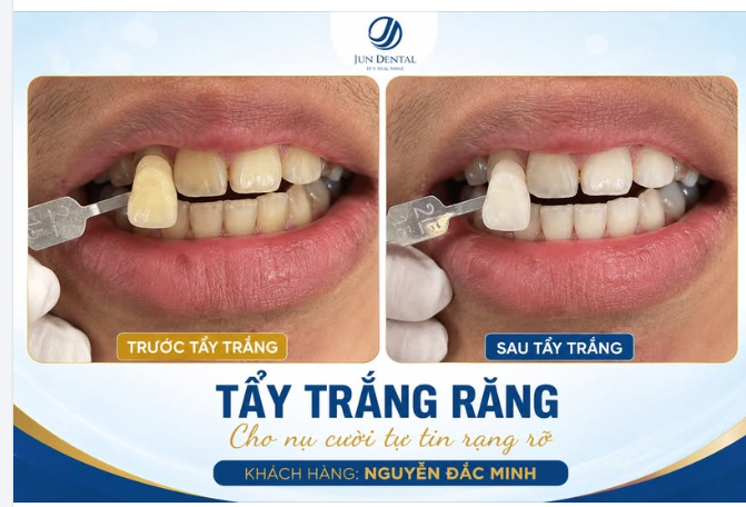 TẨY TRẮNG RĂNG – NÂNG TẦM NỤ CƯỜI TỰ TIN