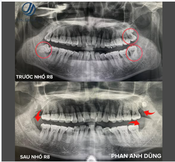 TẠM BIỆT NHỮNG CHIẾC RĂNG KHÔN GÂY PHIỀN TOÁI