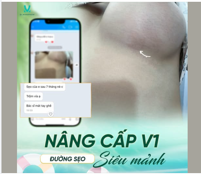 Một trong những điều khiến nhiều chị em băn khoăn trước khi nâng cấp V1 chính là “sẹo sau phẫu thuật
