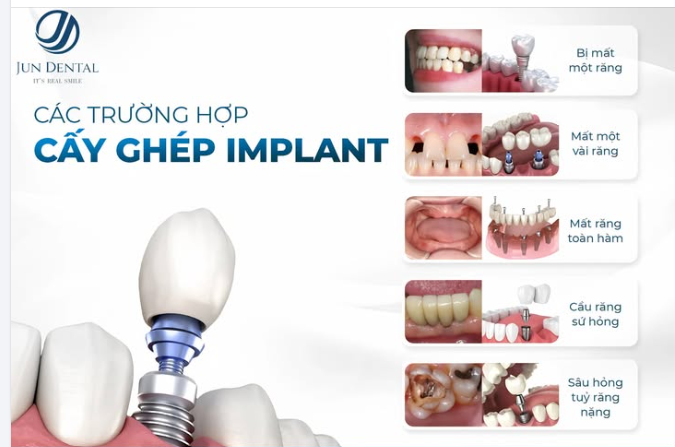 CÁC TRƯỜNG HỢP NÊN CẤY GHÉP IMPLANT – GIẢI PHÁP PHỤC HÌNH RĂNG HOÀN HẢO