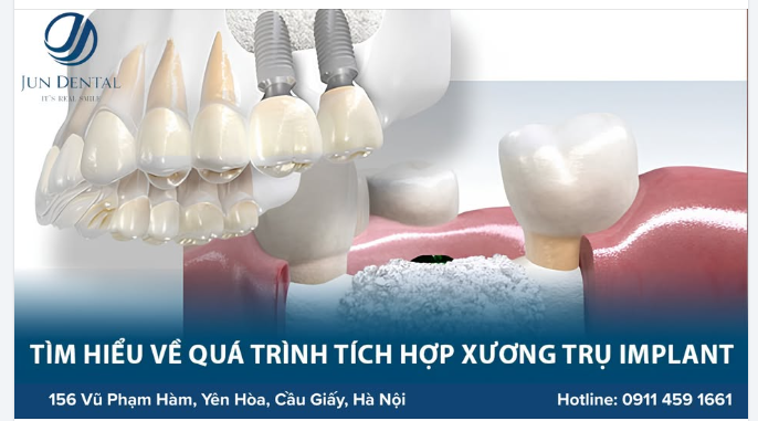 TÌM HIỂU QUÁ TRÌNH TÍCH HỢP XƯƠNG TRỤ IMPLANT – YẾU TỐ QUAN TRỌNG QUYẾT ĐỊNH THÀNH CÔNG CỦA CA CẤY GHÉP