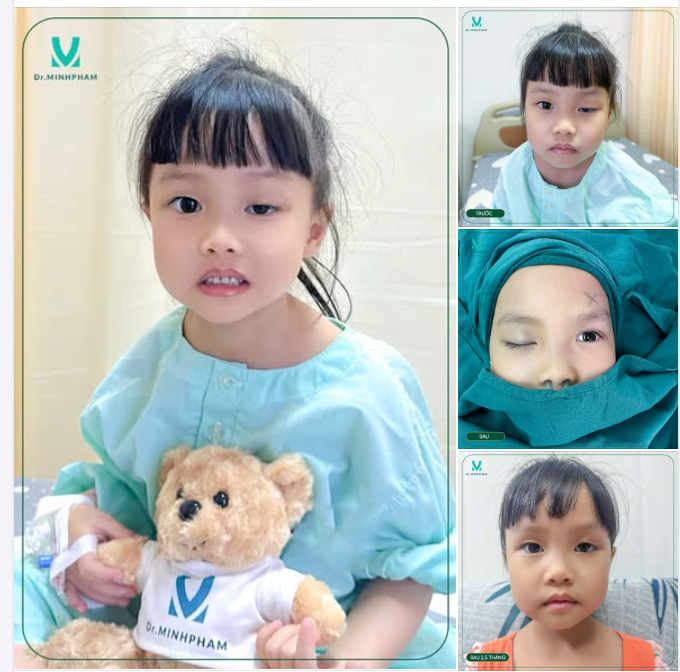 Sau phẫu thuật sụp mi bẩm sinh bằng phương pháp treo mi vạt cơ trán, kết quả thật sự đáng kinh ngạc!