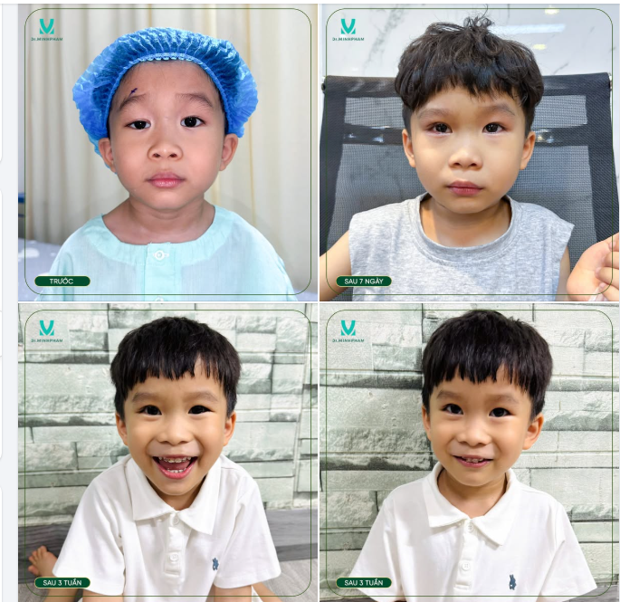 Chỉ sau 3 tuần, đôi mắt của bé Bảo Long đã mở to, cân đối và rạng rỡ hơn. Bé vui vẻ và hoạt bát hơn trong học tập và sinh hoạt