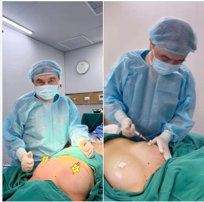 Nâng ngực = Cấy mỡ tự thân với Dr Vương