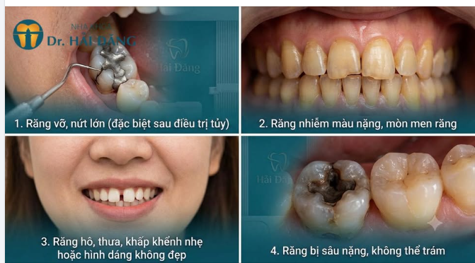 NHỮNG TRƯỜNG HỢP NÊN BỌC RĂNG SỨ – KHÔNG PHẢI AI CŨNG CẦN