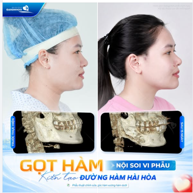 GỌT HÀM NỘI SOI VI PHẪU KIẾN TẠO ĐƯỜNG VIỀN HÀM HÀI HÒA