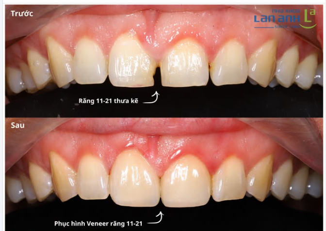 Khoảng cách chỉ đẹp khi là... khoảng cách an toàn.