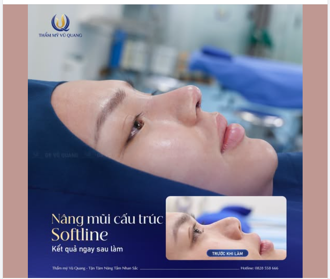 CẬN CẢNH DÁNG MŨI SOFTLINE NGAY SAU KHI LÀM – ĐẸP KHÔNG TÌ VẾT!