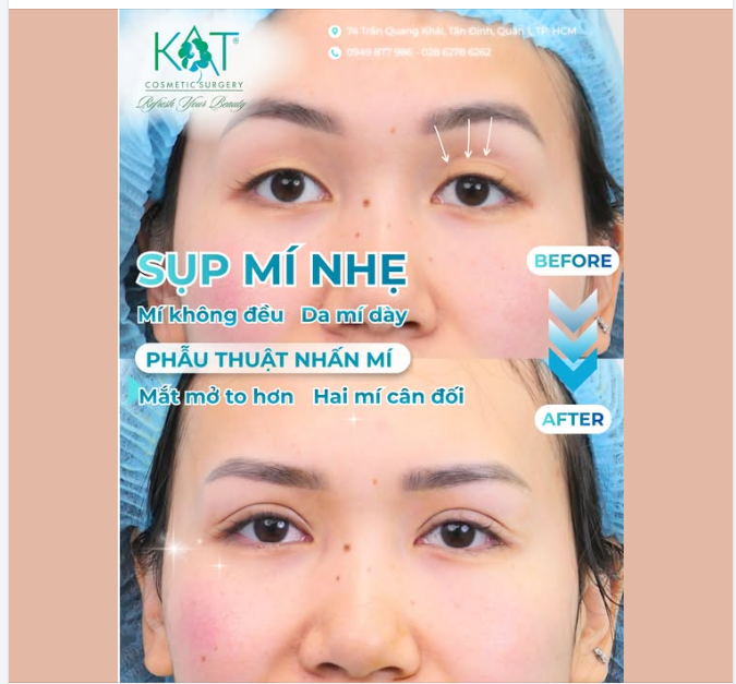 BEFORE: Sụp mí nhẹ – Mí không đều – Mắt nhìn nhỏ và thiếu chiều sâu