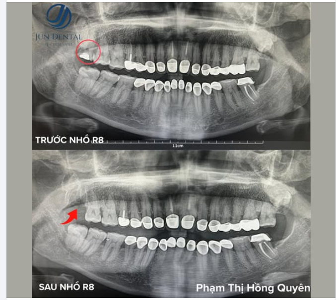 NHỔ RĂNG KHÔN KHÔNG CHỈ LÀ HẾT ĐAU