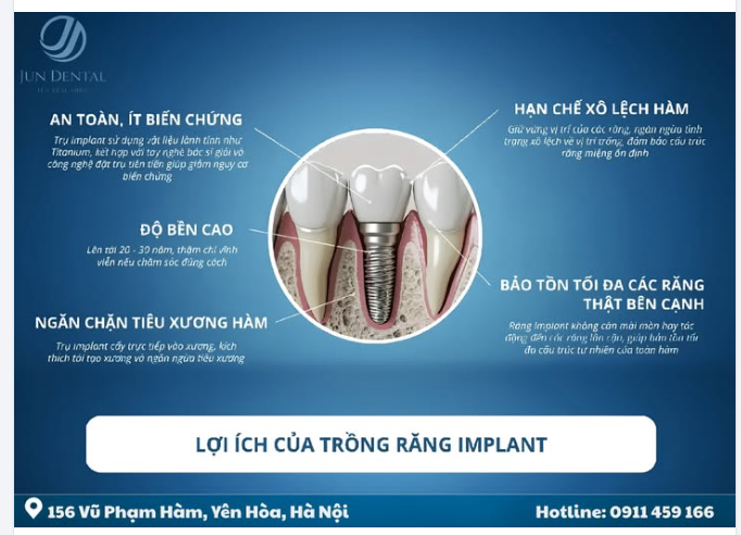 TRỒNG RĂNG IMPLANT – GIẢI PHÁP HOÀN HẢO CHO NỤ CƯỜI TỰ TIN