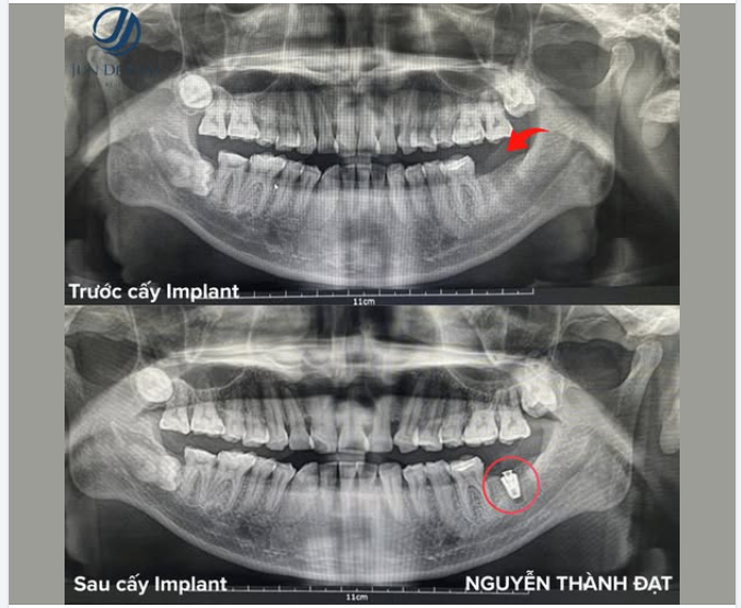 MẤT RĂNG KHÔNG CHỈ ẢNH HƯỞNG ĂN NHAI – MÀ CÒN LÀM TIÊU XƯƠNG HÀM
