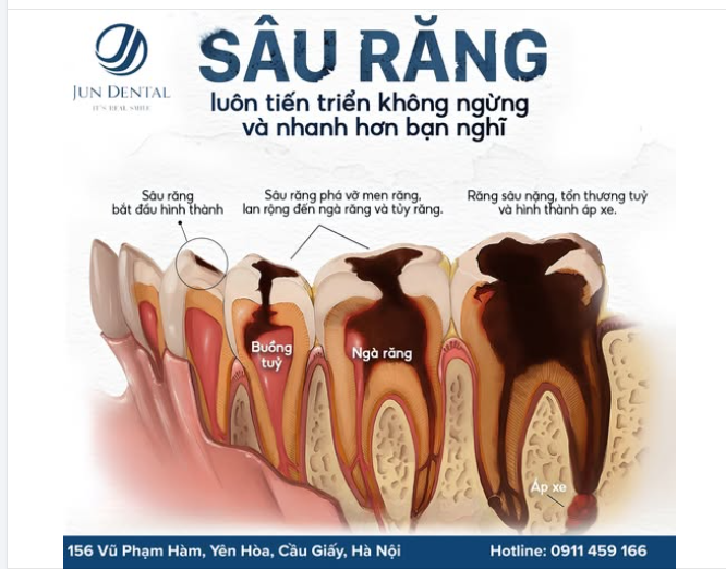 SÂU RĂNG KHÔNG TỰ KHỎI – CHỈ CÀNG NẶNG HƠN!