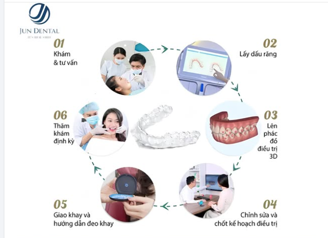 6 BƯỚC CHINH PHỤC NỤ CƯỜI HOÀN HẢO CÙNG NIỀNG RĂNG TRONG SUỐT TẠI NHA KHOA JUN DENTAL