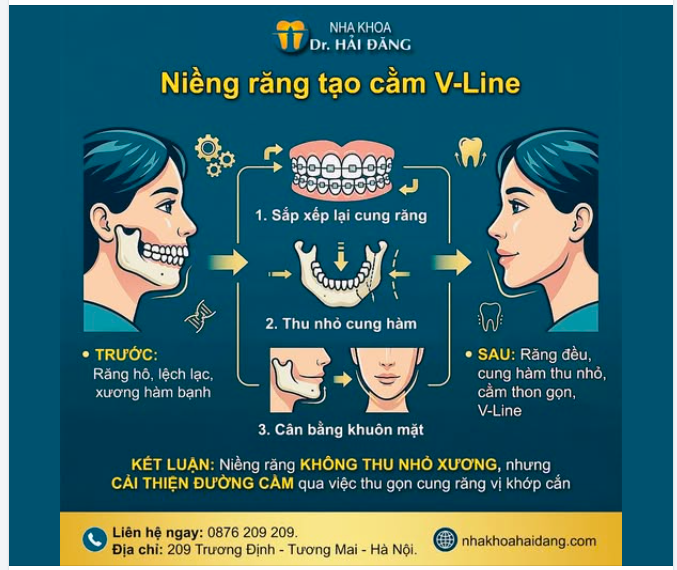 NIỀNG RĂNG CÓ GIÚP TẠO CẰM V-LINE KHÔNG