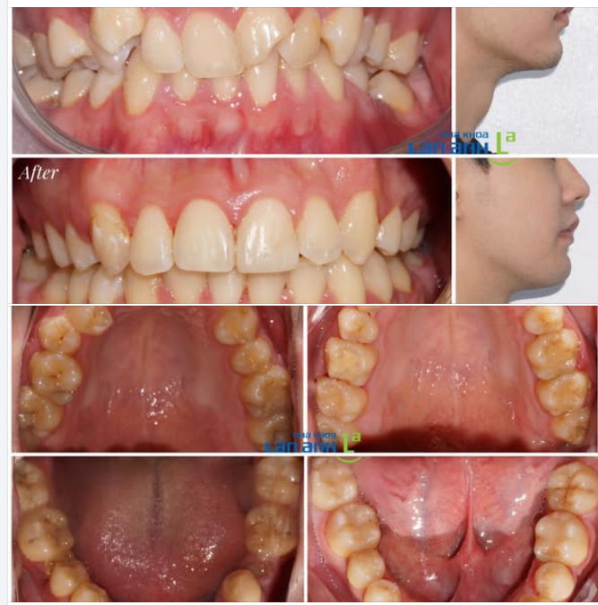 Niềng răng tại nha khoa Lan Anh ạ