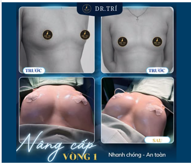 NÂNG CẤP VÒNG 1 – NÂNG SỰ TỰ TIN