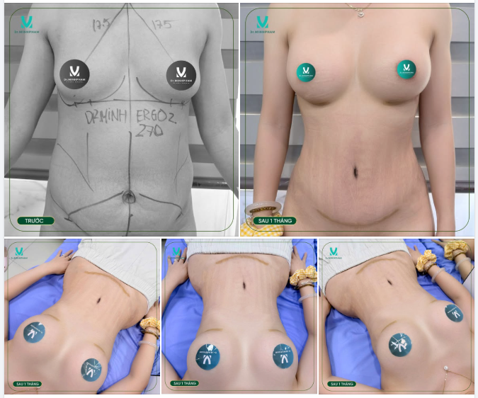 KẾT QUẢ THẬT TÁI KHÁM SAU 1 THÁNG NÂNG CẤP VÓC DÁNG TẠI DR. MINH PHẠM