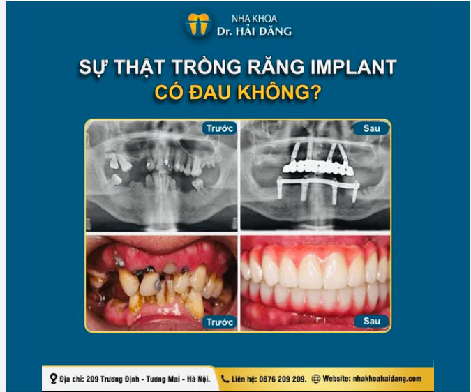 TRỒNG RĂNG IMPLANT CÓ ĐAU KHÔNG