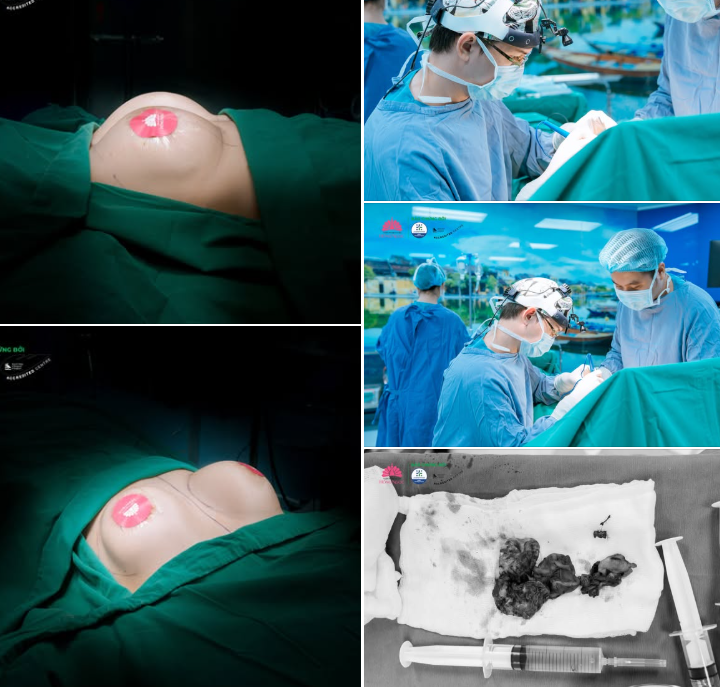 10 NĂM SAU PT NÂNG NGỰC: ĐỪNG CHỦ QUAN KHI VÒNG 1 BẮT ĐẦU "LÊN TIẾNG"