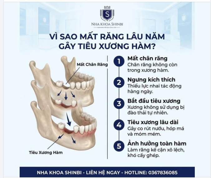 MẤT RĂNG MÀ KHÔNG TRỒNG LẠI — XƯƠNG HÀM ĐANG TỰ TIÊU MỖI NGÀY MÀ BẠN KHÔNG HAY