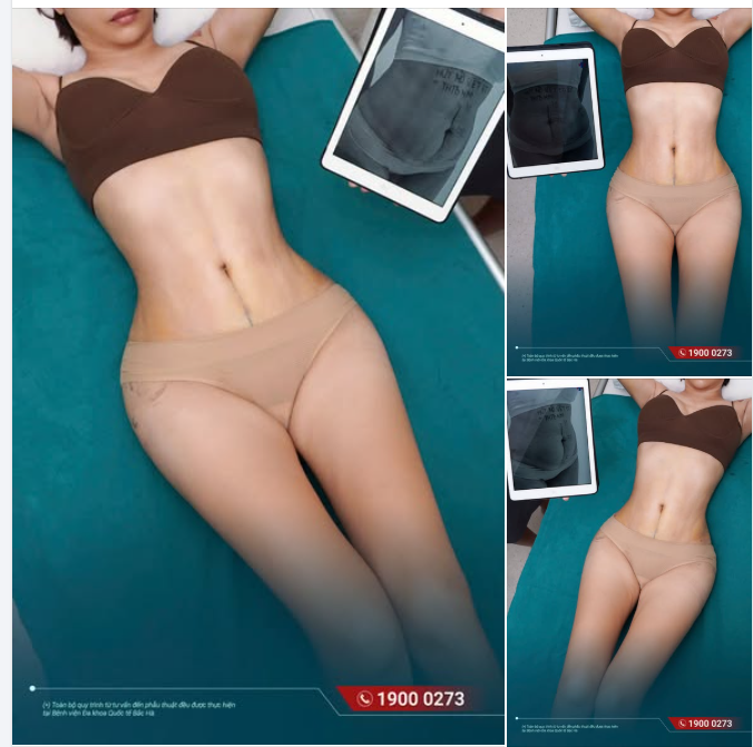 HÚT MỠ SAU BAO LÂU SẼ ĐẸP! CHI PHÍ CÓ ĐẮT KHÔNG?