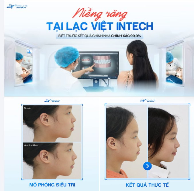 BIẾT TRƯỚC KẾT QUẢ CHỈNH NHA CHÍNH XÁC 99,9% NHỜ CÔNG NGHỆ MÔ PHỎNG ĐIỀU TRỊ