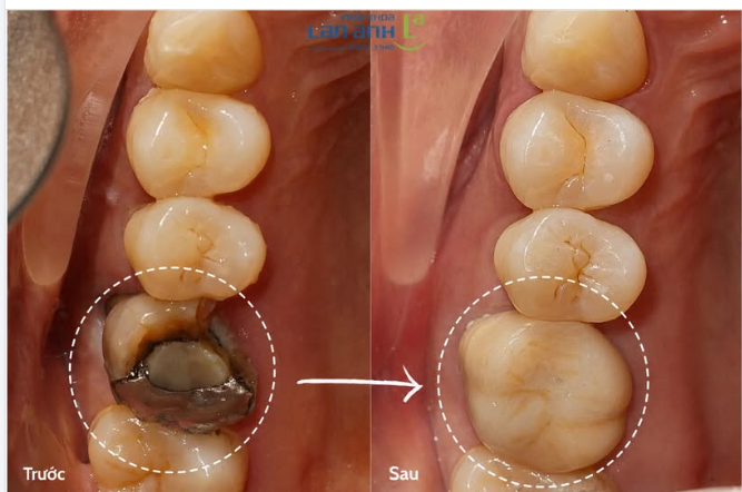 Răng cũng giống điện thoại.  Pin chai thì thay pin.  Màn hình bể thì thay màn hình.