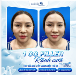 1 CC FILLER RÃNH CƯỜI  Thay đổi nhỏ, giúp gương mặt trẻ trung hơn.