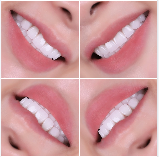 RĂNG SỨ ĐẸP KHÔNG PHẢI GIỐNG AI — MÀ PHẢI LÀ PHIÊN BẢN PHÙ HỢP NHẤT VỚI CHÍNH BẠN
