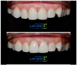 Lại thêm một trường hợp răng sứ cũ bị hở cổ nhưng được xử lý kịp thời.