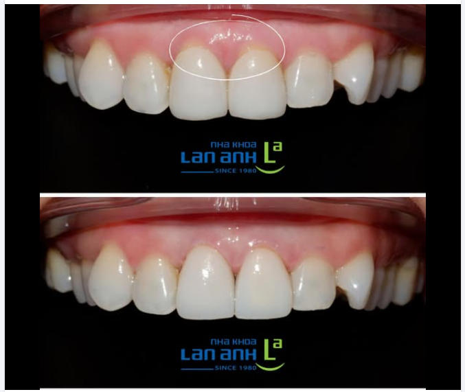Lại thêm một trường hợp răng sứ cũ bị hở cổ nhưng được xử lý kịp thời.