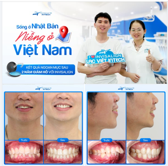 CHỌN NIỀNG RĂNG INVISALIGN TẠI VIỆT NAM KHI ĐANG SỐNG Ở NƯỚC NGOÀI