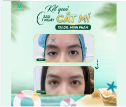 7 NGÀY SAU CẮT MÍ – SỰ THAY ĐỔI NHÌN THẤY RÕ
