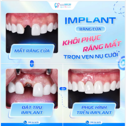 CHỈ MỘT CHIẾC RĂNG CỬA – CÓ THỂ THAY ĐỔI CẢ NỤ CƯỜ