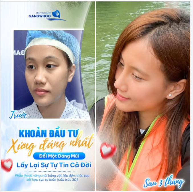 NÂNG MŨI - KHOẢN ĐẦU TƯ XỨNG ĐÁNG NHẤT