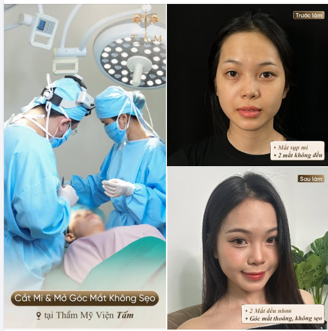 Không cần dậy sớm để kích mí, kẻ mắt mỗi ngày. Chị M.T giờ đã sở hữu đôi mắt như ý sau khi thực hiện Combo Cắt mí và Mở góc trong tại Tấm.