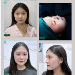 Kết quả không chỉ nằm ở một dáng mũi đẹp hơn mà còn là sự hài hòa với tổng thể gương mặt và vẻ tự nhiên