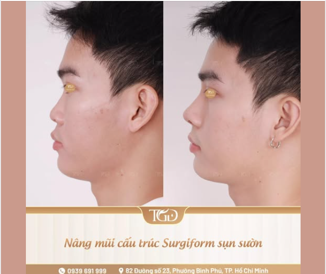 Nâng mũi cấu trúc Nam – Tôn đường nét nam tính, hài hòa