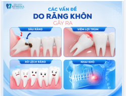 RĂNG KHÔNG "KHÔN" NHƯ BẠN NGHĨ: 5 BIẾN CHỨNG DỄ GẶP KHI RĂNG KHÔN MỌC LỆCH!