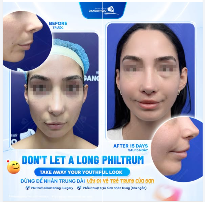Sau 15 ngày phẫu thuật thu ngắn nhân trung: