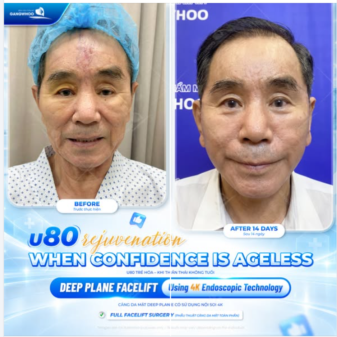 U80 TRẺ HÓA – KHI THẦN THÁI KHÔNG TUỔI