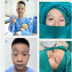 KẾT QUẢ SAU PHẪU THUẬT TREO MI VCT MẮT PHẢI KẾT HỢP CẮT MÍ MẮT TRÁI